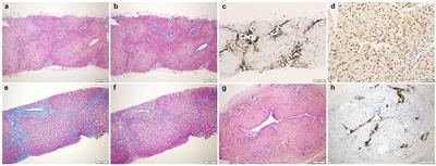 Case report: Unusual and extremely severe lipoprotein X-mediated hypercholesterolemia in extrahepatic pediatric cholestasis